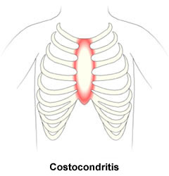 Costochondritis