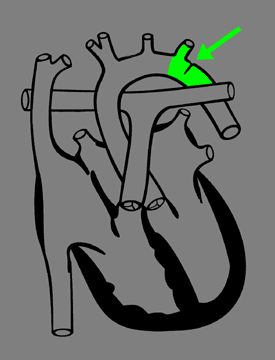 Coarctation