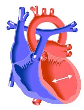 Dilated Cardiomyopathy