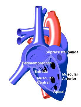 Variations of VSD