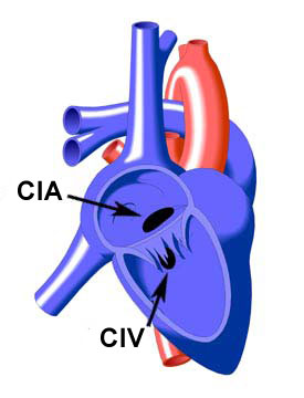 Endocardial Cushion Defect