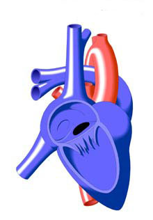 Atrial Septal Defect