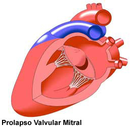 Mitral Valve Prolapse