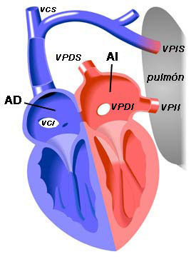 Drenaje Anómalo Parcial de Venas Pulmonares